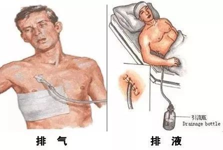 置管位置(3)当患者有液气胸时,既需要引流胸水,又需要引流气体,那就
