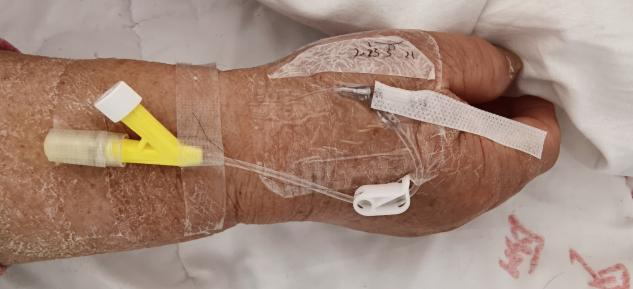 该怎么拯救你被强拉硬拽的留置针