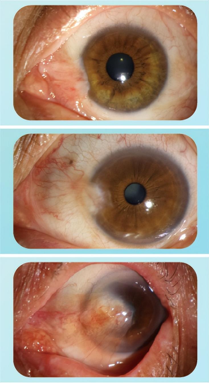 眼睛为什么会长胬肉