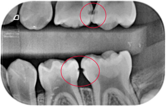 牙缝出现早期邻面龋为什么叫咬合翼片呢?