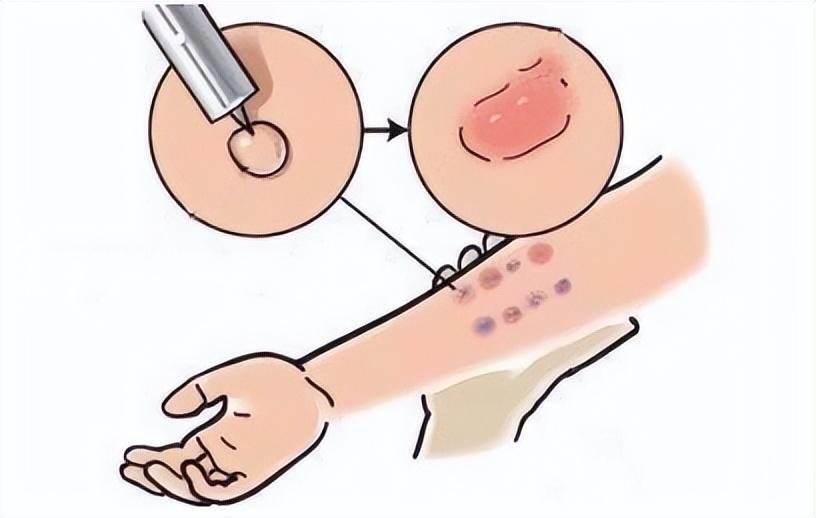 新生入学结核菌素试验(ppd)筛查攻略来啦!