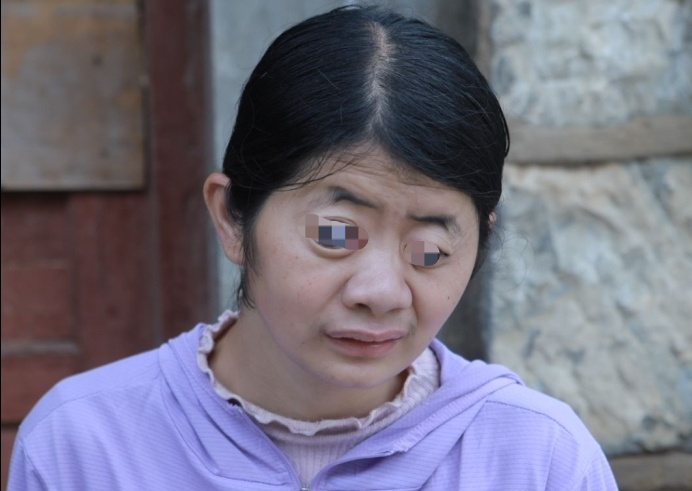 母亲患"白瞳"村民看见躲着走,爸爸意外截肢不能务农