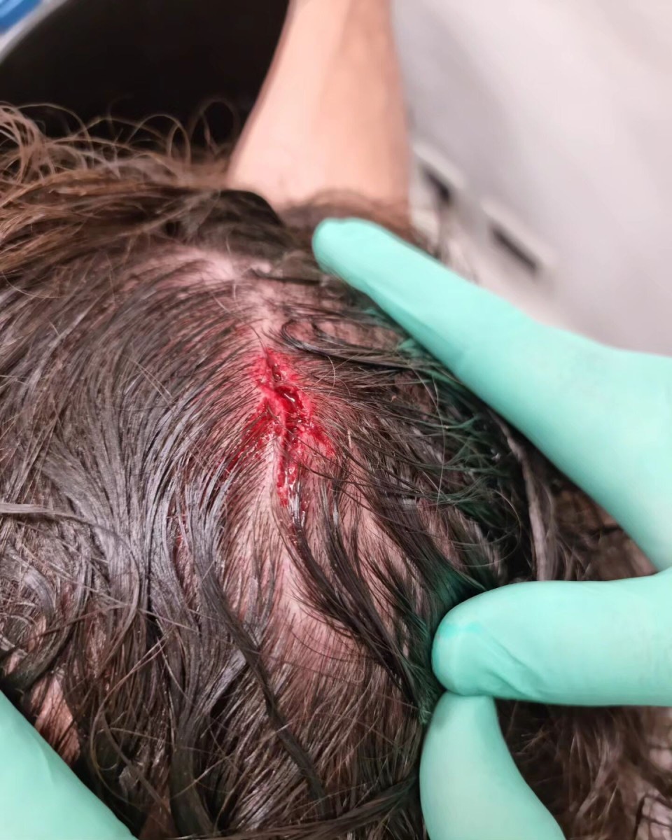 伊布晒头部受伤并进行缝针照片:比赛的一部分