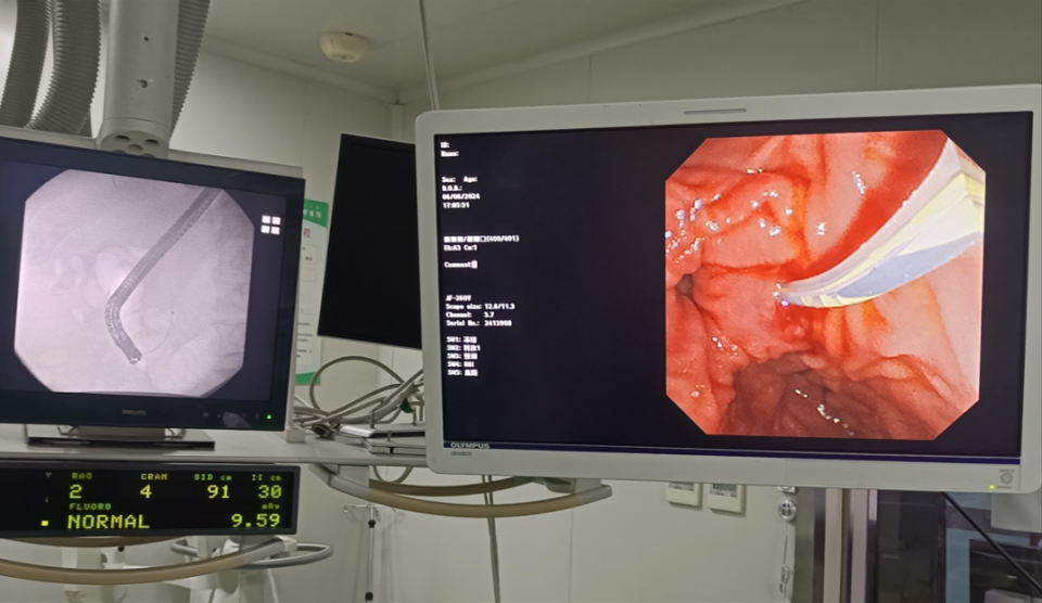 "镜"益求精——ercp技术成功为73岁患者巧取结石