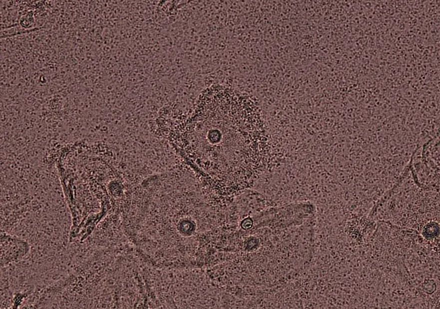 细胞边缘呈锯齿状,表面黏附大量加德纳菌及其他短杆菌,呈线索状排布