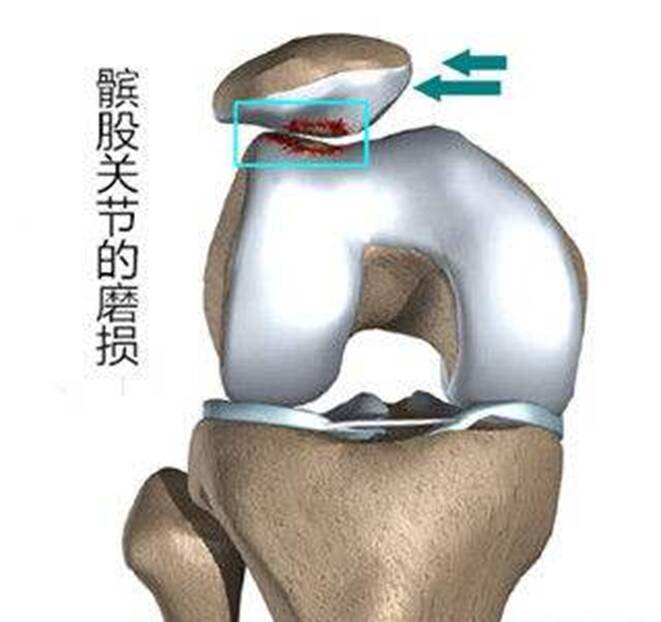 髌骨外侧关节面压力过大,从而引起髌前区软骨过度受压,引起膝盖疼痛