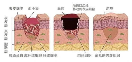 瘢痕组织画图图片