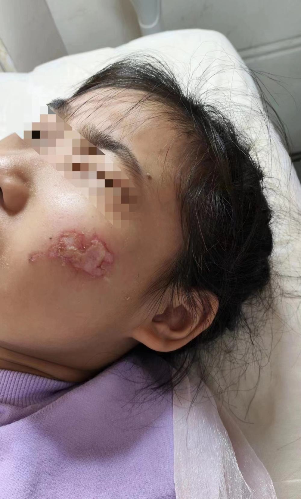 生日音乐蜡烛存隐患女童过生日脸部遭炸伤厂家称或为底部电池爆炸