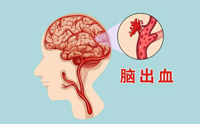 长沙一男子酒后头痛持续,竟是脑出血