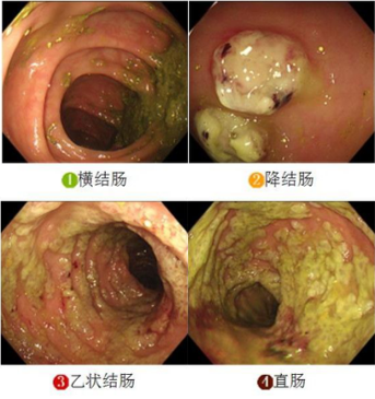 伪膜性肠炎大便特征图片