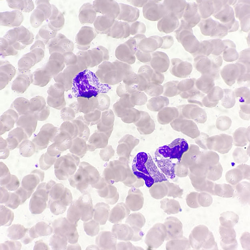 嗜酸性粒细胞增高你遇到这种疾病么