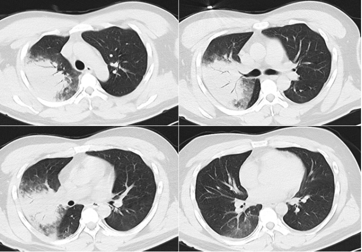 从6个典型案例,看疑难重症肺部感染的综合判断和处理!