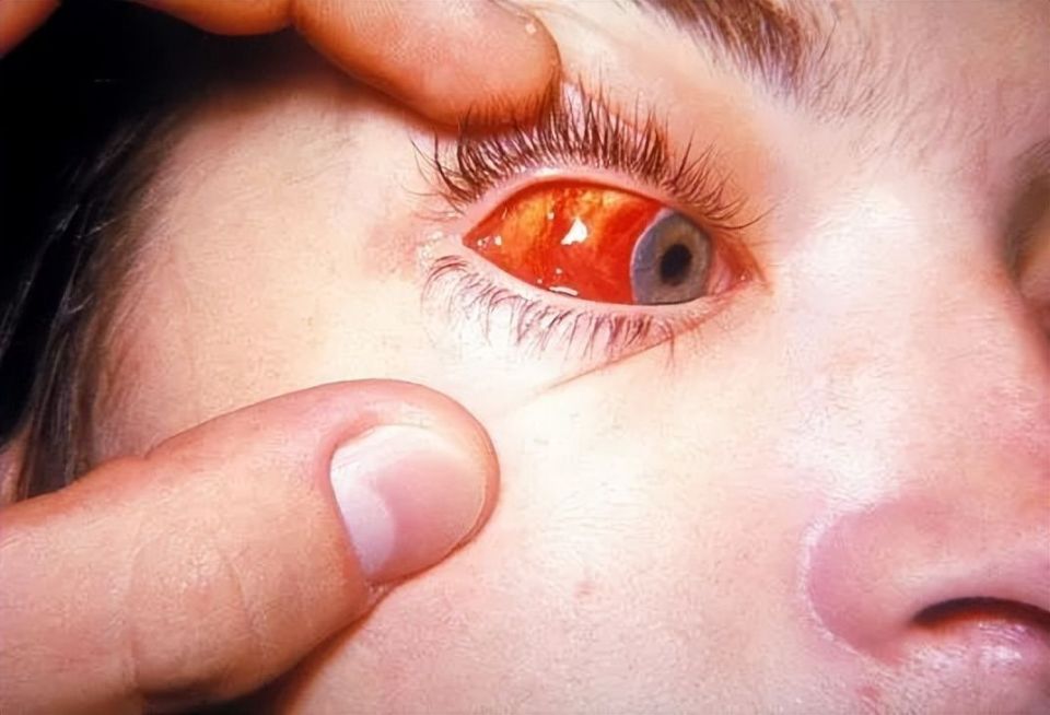 【疾控中心提示】:谨防你的眼红是病!红眼病如何用对药