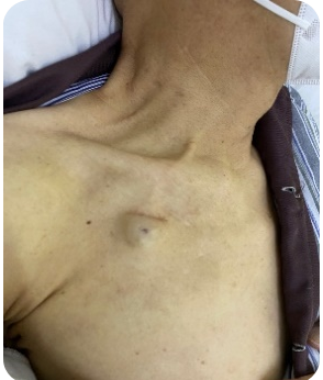 关于输液港那些事儿看这一篇就够了