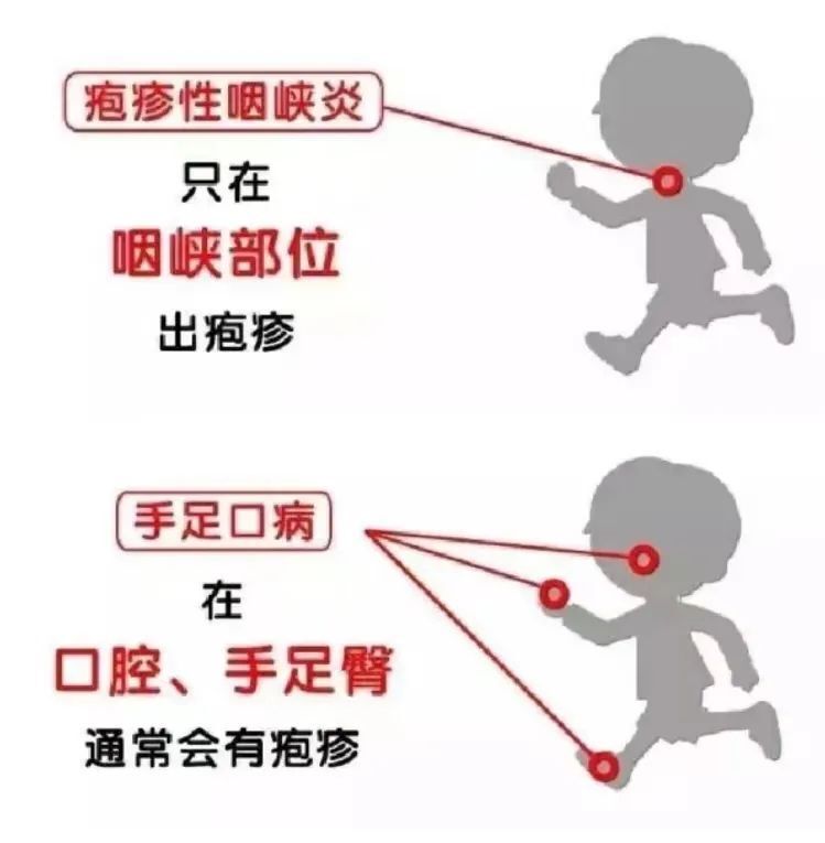 手足口病还是疱疹性咽峡炎一文教你怎么区分和预防