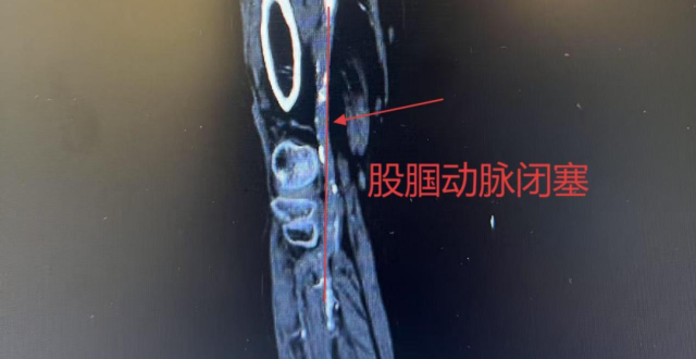 滨州市人民医院毫米级穿刺巧通血管，98岁超高龄患者重新迈步_腾讯新闻