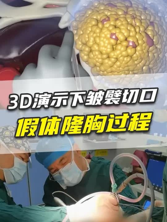 下皱襞切口隆胸如何操作？3d演示揭秘！_腾讯新闻