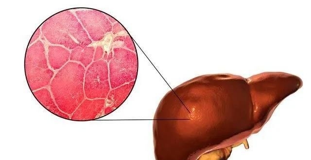 揭秘肝内钙化灶：背后的真相和应对策略_腾讯新闻