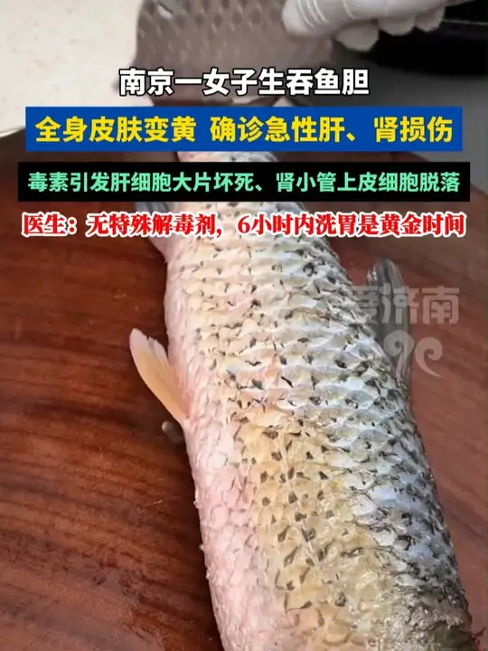 南京一女子生吞鱼胆！全身皮肤变黄，确诊急性肝、肾损伤_腾讯新闻