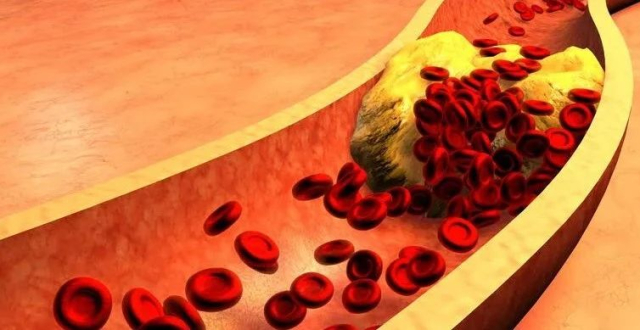 确诊了动脉斑块，还有机会逆转吗？做对6件事，斑块或可逐渐消散_腾讯新闻