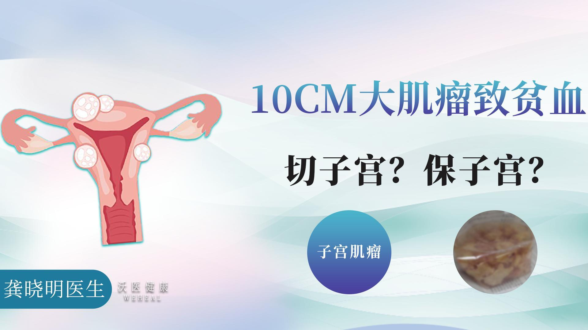 10cm大肌瘤致贫血：切子宫？保子宫？_腾讯新闻