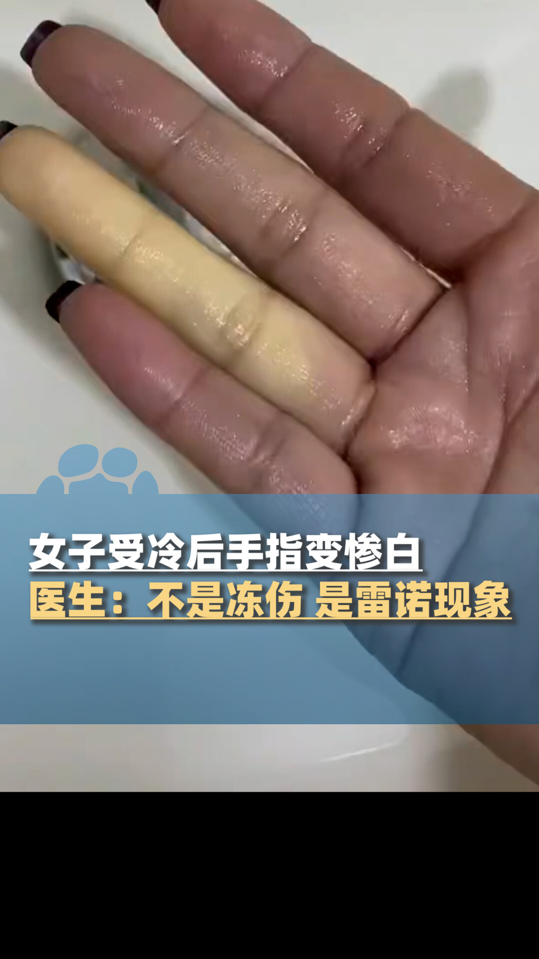 女子受冷后手指变惨白，医生：不是普通冻伤，是雷诺现象_腾讯新闻