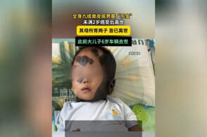 全身90%“兽皮痣”的患儿乐宝因癌变离世，这是什么病？产检为何没能提前发现？