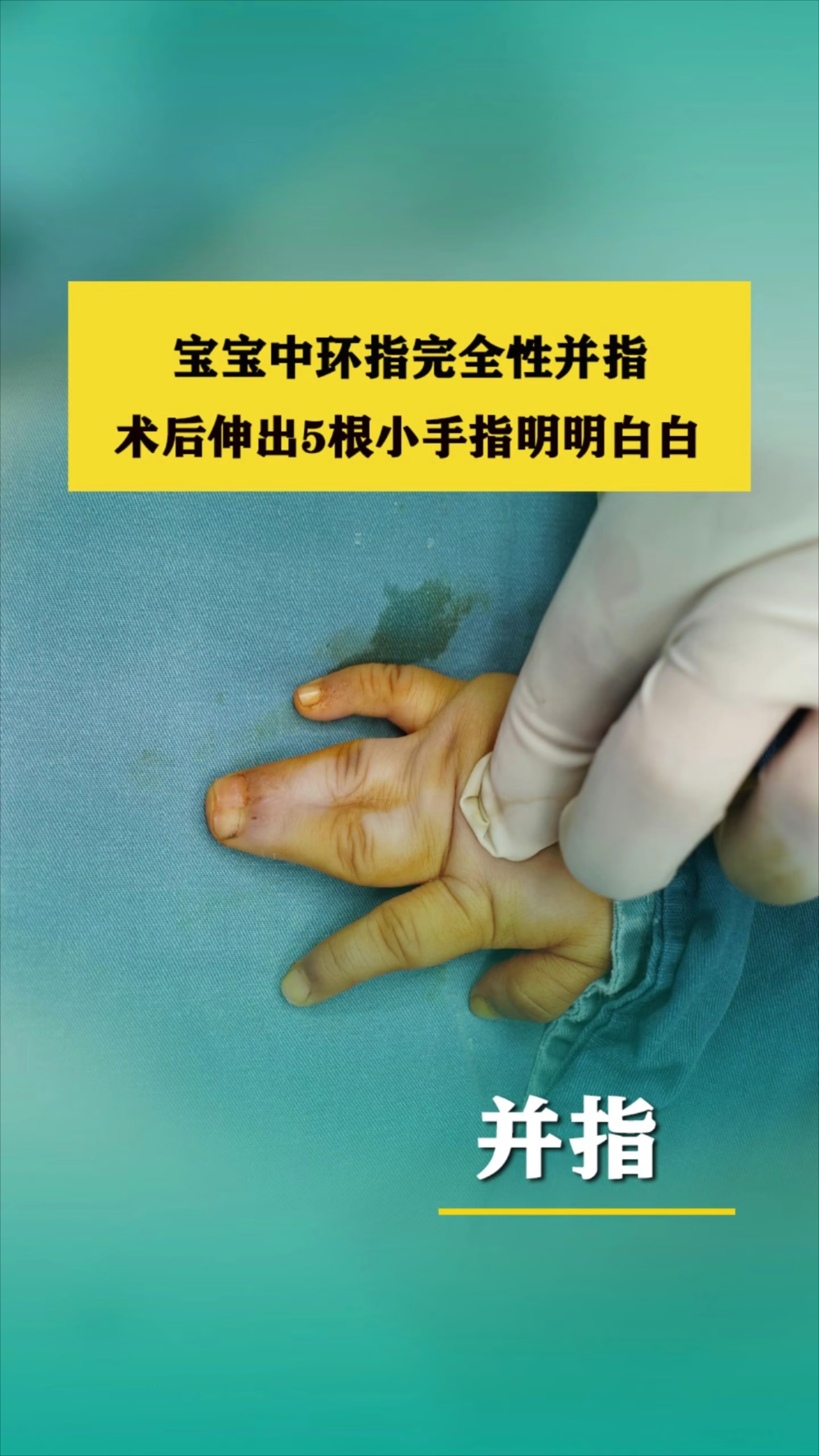 宝宝中环指完全性并指，术后伸出5根小手指明明白白_腾讯新闻