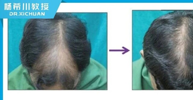 米诺地尔进阶用法，发量超级加倍_腾讯新闻