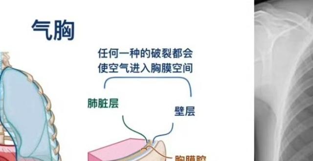 气胸的时候肺会被压扁_腾讯新闻