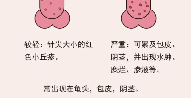 包皮龟头红肿、瘙痒还长红点，是怎么回事？_腾讯新闻
