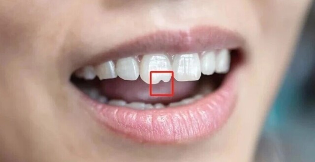 门牙前的“豁”真是嗑瓜子惹的祸？多年来的困惑终于解开了！缩略图