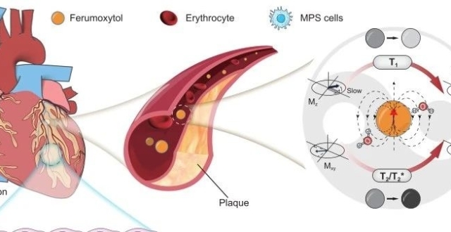 Ferumoxytol增强MRI：揭幕下一代磁共振对比剂_腾讯新闻