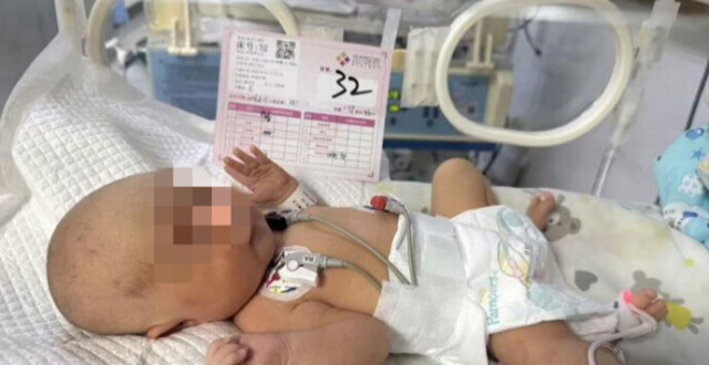 延安护工致新生儿颅骨骨折