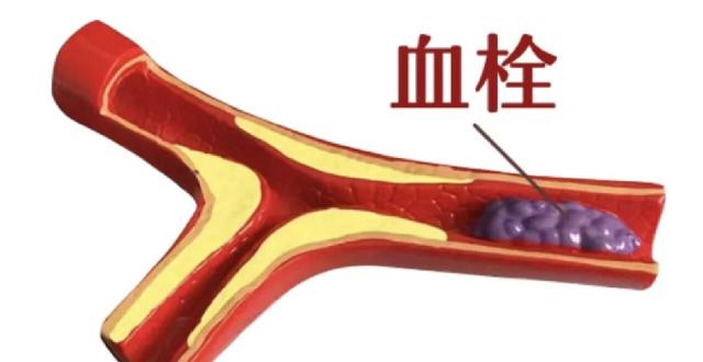日常出现这些症状要注意，小心血栓发生，7类人群容易得血栓_腾讯新闻