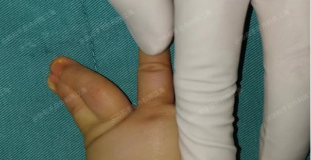 并指免植皮｜案例10《宝宝两根手指并成一根，术后恢复正常五指》_腾讯新闻