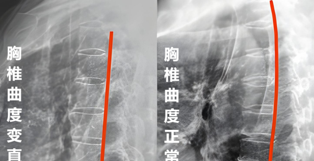 生理曲度变直、反弓，是怎么回事？可以做哪些锻炼？_腾讯新闻