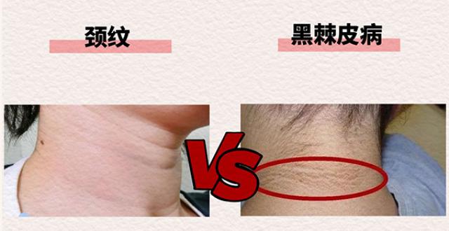 脖子黑洗不掉？松山医院：可能是黑棘皮病_腾讯新闻